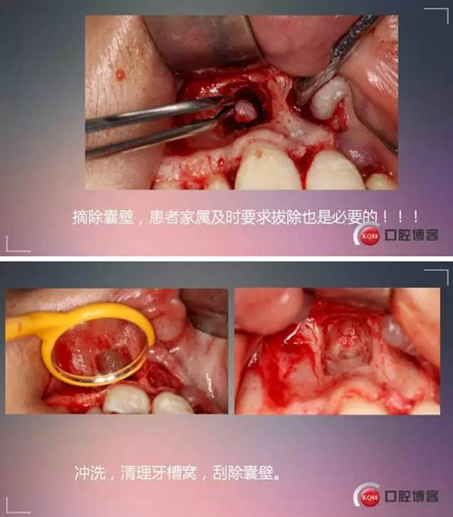 深部埋伏多生牙&mdash;&mdash;微創(chuàng)處理  