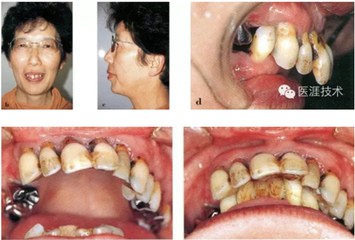 全口拔牙即戴全口活動義齒修復病例 全口拔牙即戴全口活動義齒修復病例