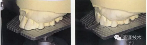 全口拔牙即戴全口活動義齒修復病例 全口拔牙即戴全口活動義齒修復病例