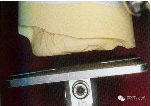 全口拔牙即戴全口活動義齒修復病例 全口拔牙即戴全口活動義齒修復病例