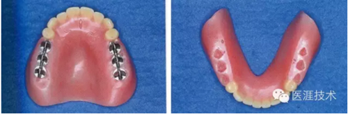 全口拔牙即戴全口活動義齒修復病例 全口拔牙即戴全口活動義齒修復病例
