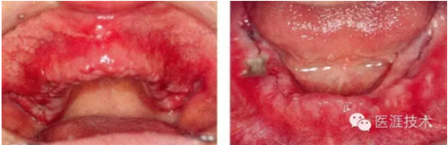 全口拔牙即戴全口活動義齒修復病例 全口拔牙即戴全口活動義齒修復病例