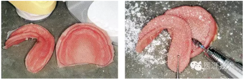 全口拔牙即戴全口活動義齒修復病例 全口拔牙即戴全口活動義齒修復病例