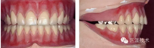 全口拔牙即戴全口活動義齒修復病例 全口拔牙即戴全口活動義齒修復病例