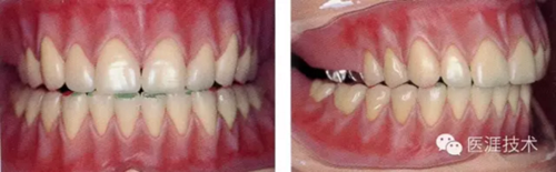 全口拔牙即戴全口活動義齒修復病例 全口拔牙即戴全口活動義齒修復病例