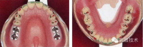 全口拔牙即戴全口活動義齒修復病例 全口拔牙即戴全口活動義齒修復病例