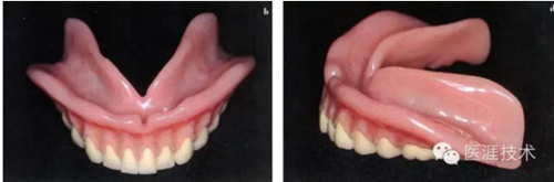 全口拔牙即戴全口活動義齒修復病例 全口拔牙即戴全口活動義齒修復病例