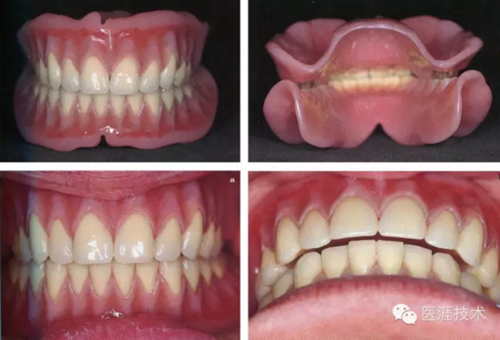 全口拔牙即戴全口活動義齒修復病例 全口拔牙即戴全口活動義齒修復病例