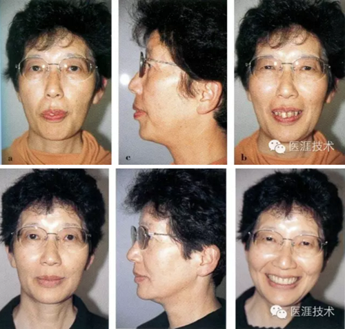 全口拔牙即戴全口活動義齒修復病例 全口拔牙即戴全口活動義齒修復病例