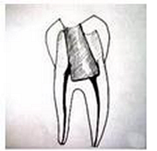 彎曲根管預(yù)備的方法和技巧 彎曲根管預(yù)備的方法和技巧