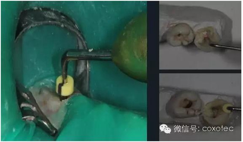 熱牙膠根管填充常見問題解答 熱牙膠根管填充常見問題解答