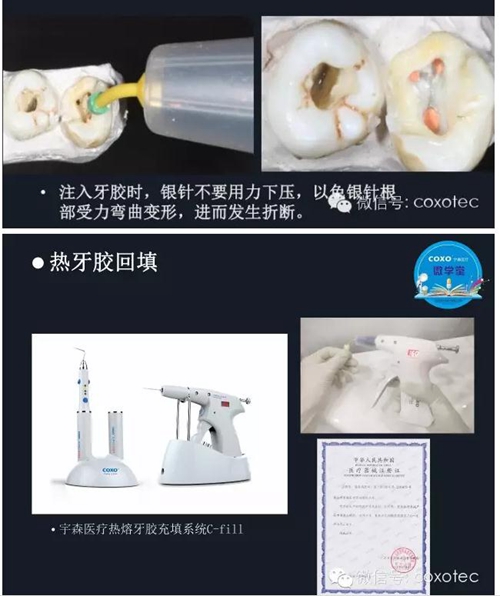 熱牙膠根管填充常見問題解答 熱牙膠根管填充常見問題解答