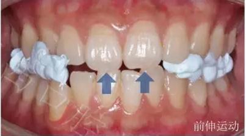 口腔材料對(duì)MRI檢查的影像到底有多大？  