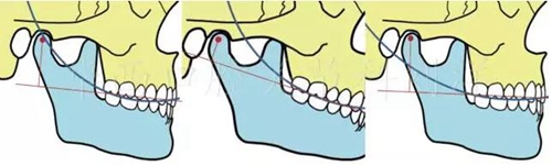 口腔材料對(duì)MRI檢查的影像到底有多大？  