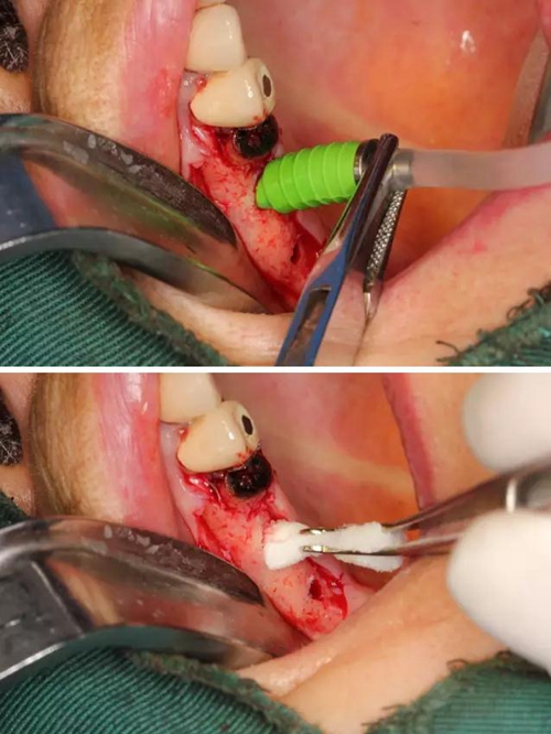 牙周病患者的外提升 牙周病患者的外提升