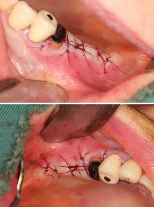 牙周病患者的外提升 牙周病患者的外提升