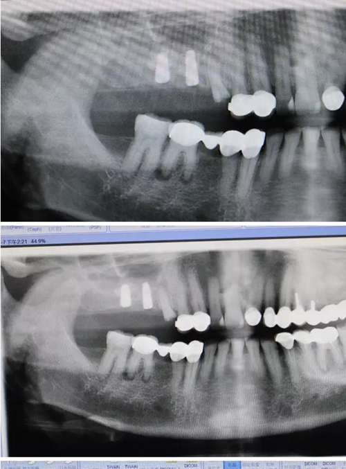 牙周病患者的外提升 牙周病患者的外提升