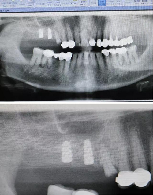 牙周病患者的外提升 牙周病患者的外提升