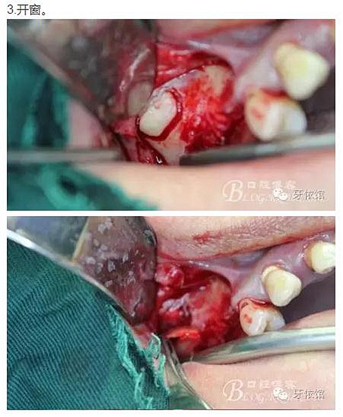 牙周病患者的外提升 牙周病患者的外提升