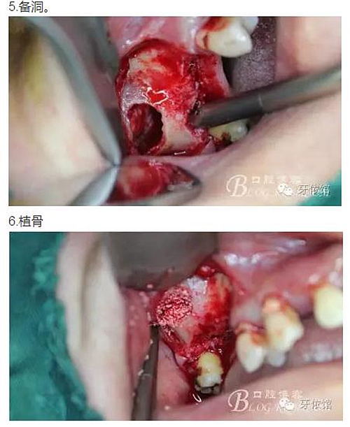 牙周病患者的外提升 牙周病患者的外提升