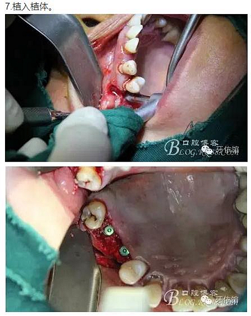 牙周病患者的外提升 牙周病患者的外提升