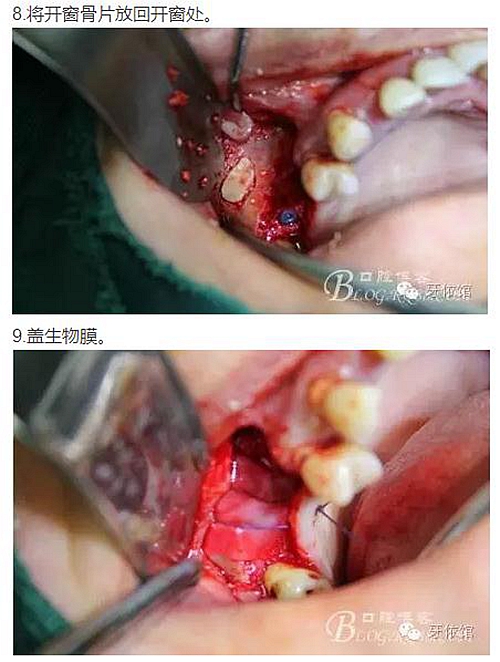 牙周病患者的外提升 牙周病患者的外提升