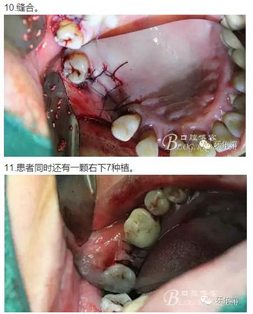 牙周病患者的外提升 牙周病患者的外提升