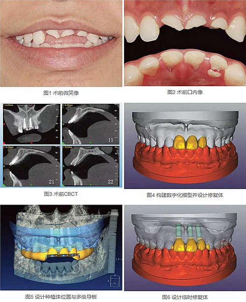 上頜多顆相鄰前牙的&ldquo;精確化&rdquo;即刻種植修復