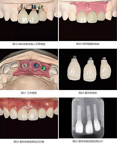 上頜多顆相鄰前牙的&ldquo;精確化&rdquo;即刻種植修復