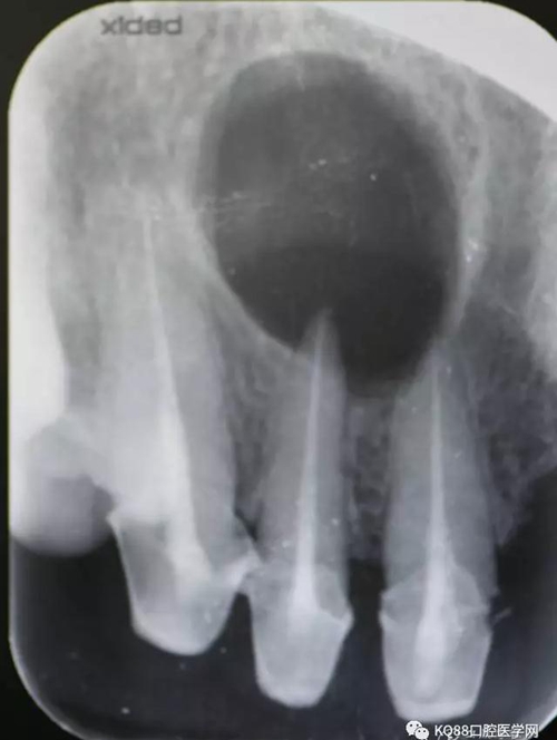 上頜側(cè)切牙根尖手術(shù)——張東星 上頜側(cè)切牙根尖手術(shù)——張東星