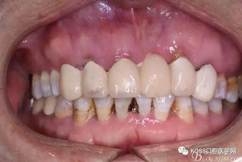 上頜側(cè)切牙根尖手術(shù)——張東星 上頜側(cè)切牙根尖手術(shù)——張東星