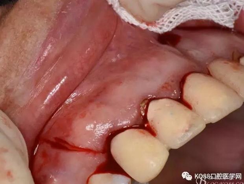 上頜側(cè)切牙根尖手術(shù)——張東星 上頜側(cè)切牙根尖手術(shù)——張東星