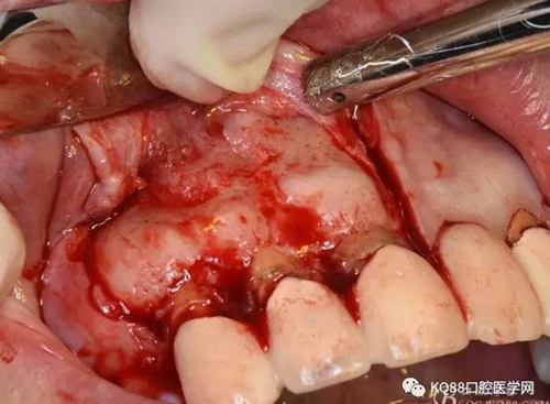 上頜側(cè)切牙根尖手術(shù)——張東星 上頜側(cè)切牙根尖手術(shù)——張東星