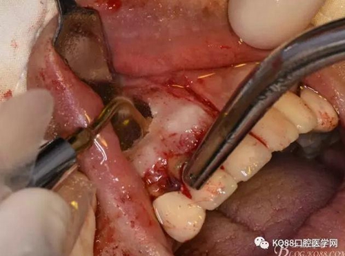 上頜側(cè)切牙根尖手術(shù)——張東星 上頜側(cè)切牙根尖手術(shù)——張東星