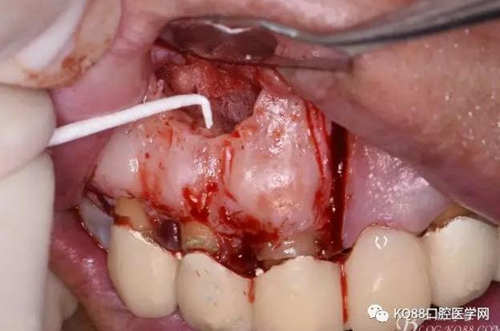 上頜側(cè)切牙根尖手術(shù)——張東星 上頜側(cè)切牙根尖手術(shù)——張東星