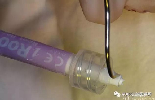 上頜側(cè)切牙根尖手術(shù)——張東星 上頜側(cè)切牙根尖手術(shù)——張東星