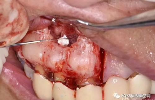 上頜側(cè)切牙根尖手術(shù)——張東星 上頜側(cè)切牙根尖手術(shù)——張東星