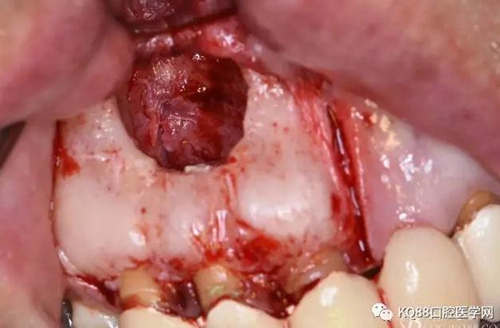 上頜側(cè)切牙根尖手術(shù)——張東星 上頜側(cè)切牙根尖手術(shù)——張東星