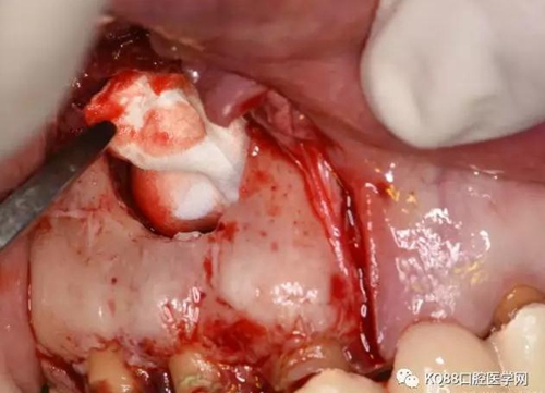 上頜側(cè)切牙根尖手術(shù)——張東星 上頜側(cè)切牙根尖手術(shù)——張東星