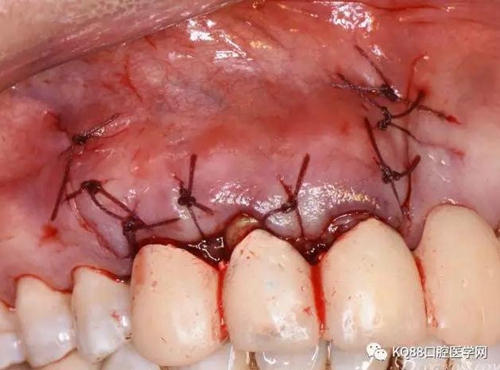 上頜側(cè)切牙根尖手術(shù)——張東星 上頜側(cè)切牙根尖手術(shù)——張東星