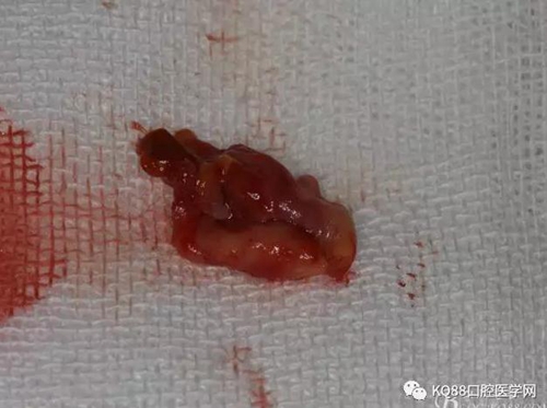 上頜側(cè)切牙根尖手術(shù)——張東星 上頜側(cè)切牙根尖手術(shù)——張東星