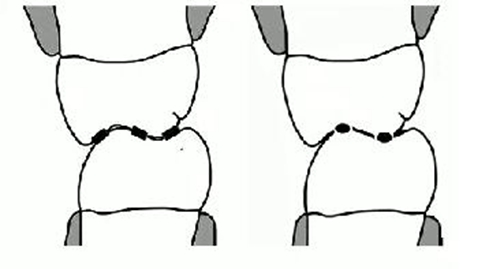 凸凹式后牙咬合接觸及其臨床意義——王美青教授 凸凹式后牙咬合接觸及其臨床意義——王美青教授