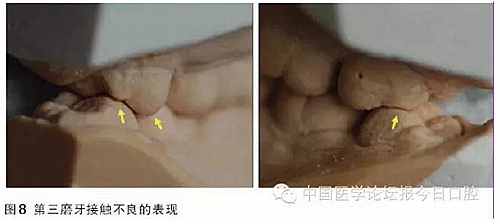 凸凹式后牙咬合接觸及其臨床意義——王美青教授 凸凹式后牙咬合接觸及其臨床意義——王美青教授