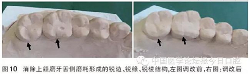 凸凹式后牙咬合接觸及其臨床意義——王美青教授 凸凹式后牙咬合接觸及其臨床意義——王美青教授