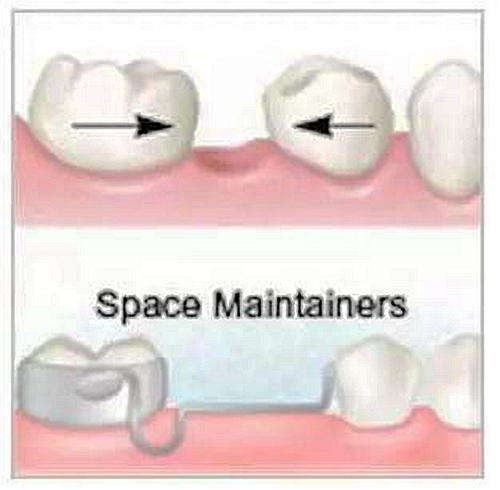 乳牙缺失致恒牙&ldquo;亂長&rdquo;，這個(gè)&ldquo;間隙保持器&rdquo;可預(yù)防