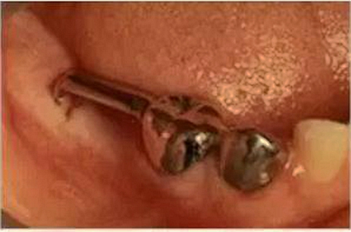 乳牙缺失致恒牙&ldquo;亂長&rdquo;，這個(gè)&ldquo;間隙保持器&rdquo;可預(yù)防