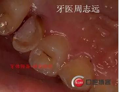 根尖誘導(dǎo)成型術(shù) 根尖誘導(dǎo)成型術(shù)