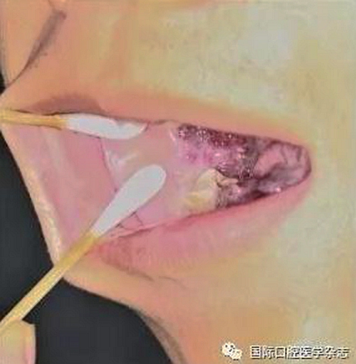 張清彬談張口受限 