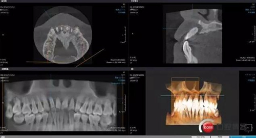 一例前牙重度牙周病8個月的種植漫長修復(fù) 一例前牙重度牙周病8個月的種植漫長修復(fù)
