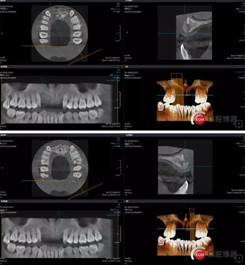 一例前牙重度牙周病8個月的種植漫長修復(fù) 一例前牙重度牙周病8個月的種植漫長修復(fù)